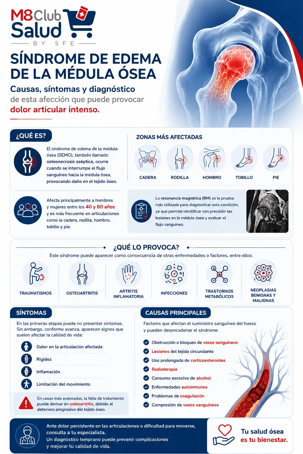 Infografía sobre síndrome de edema de la médula ósea: causas, síntomas, diagnóstico y articulaciones afectadas. Infografía médica del síndrome de edema de la médula ósea que muestra causas, síntomas, diagnóstico mediante resonancia magnética y zonas afectadas como cadera, rodilla, hombro, tobillo y pie.