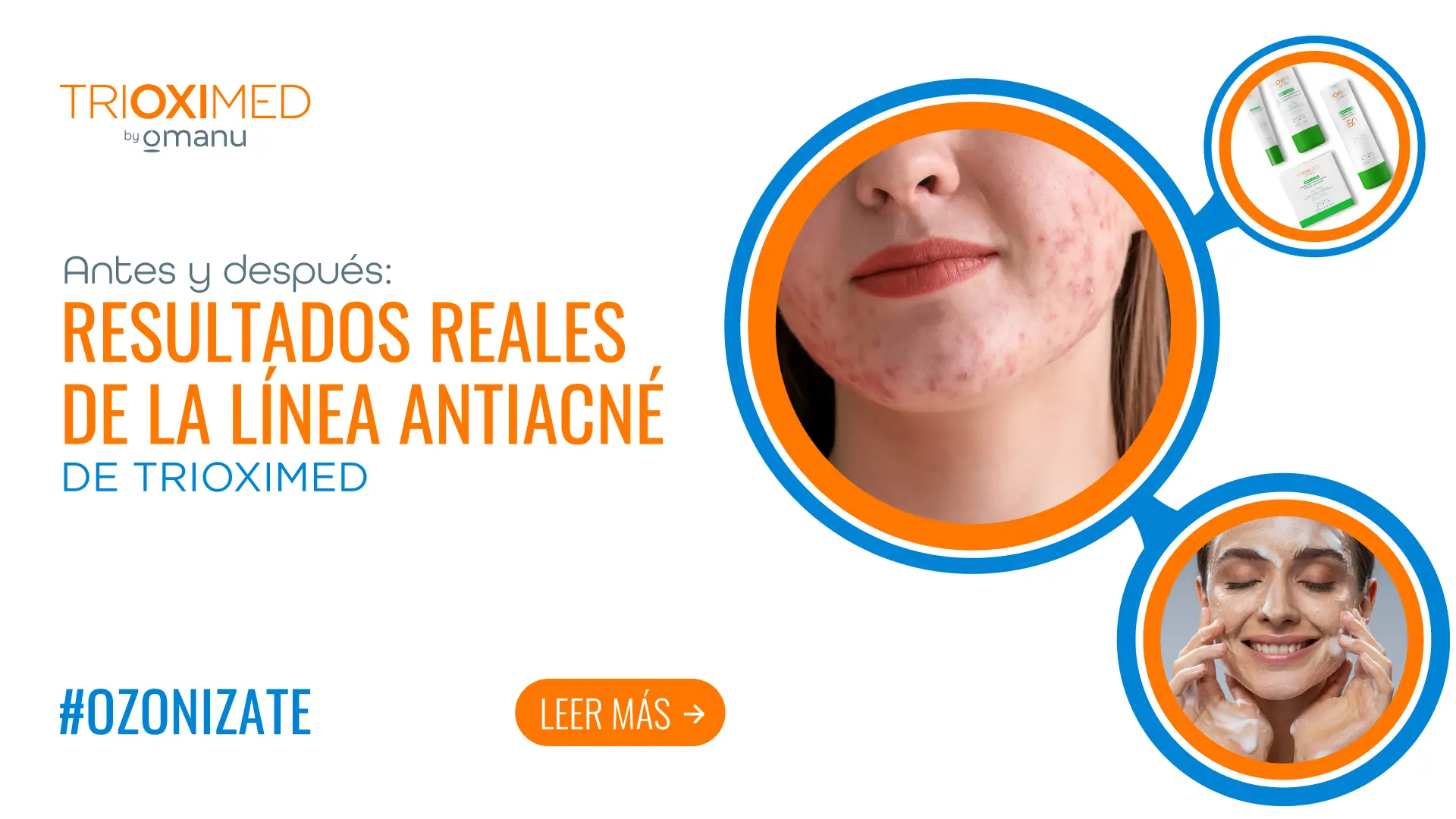 Antes y después con resultados reales de la línea antiacné de Trioximed by Omanu, mostrando mejora visible en piel con acné