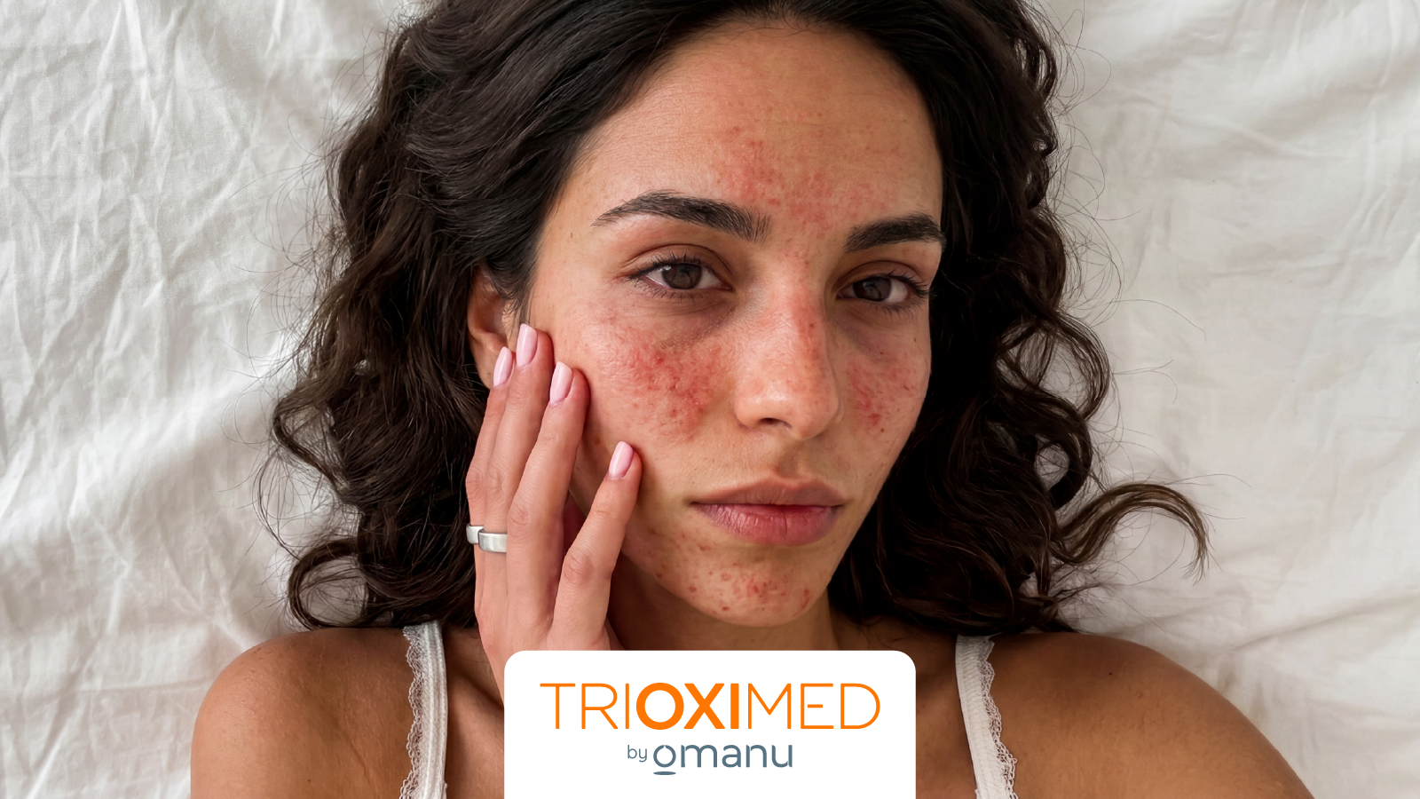 Mujer con enrojecimiento e irritación facial mostrando signos de una barrera cutánea dañada por errores en la rutina skincare.