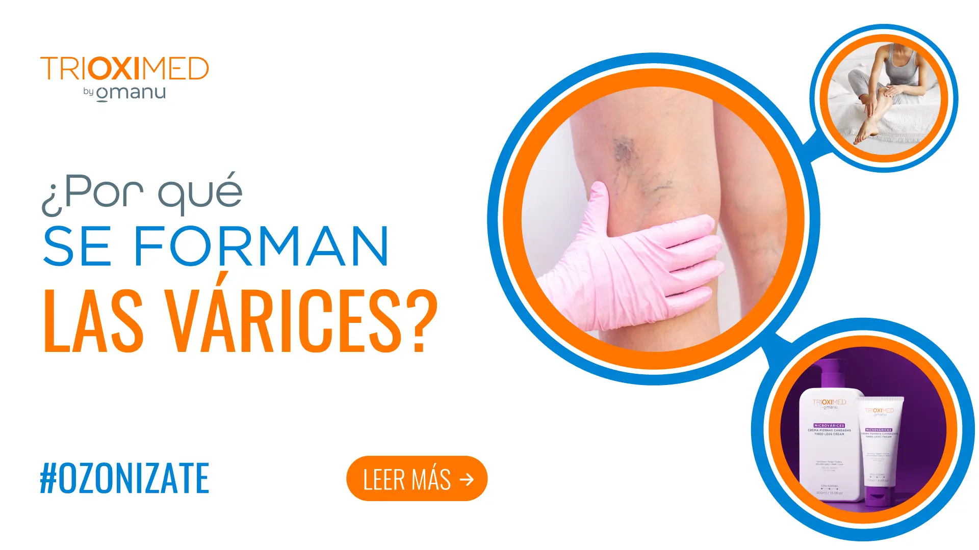 Por qué se forman las várices, con imagen de piernas con arañas vasculares, atención médica y productos para tratamiento