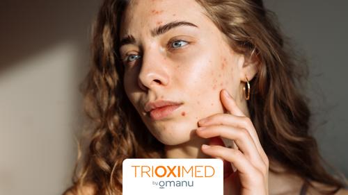 Mujer con acné facial durante un tratamiento para controlar los brotes.