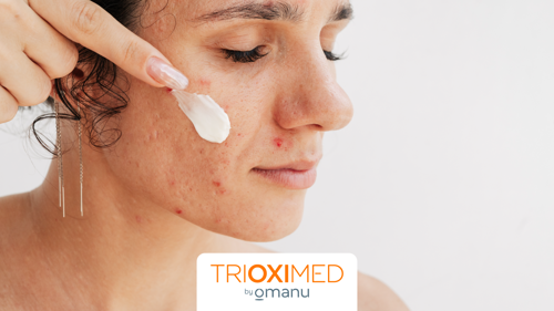 Mujer con acné aplicando crema sobre el rostro para cuidar la piel.