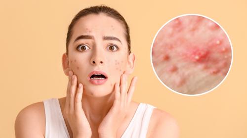 ¿Acné en el rostro?: La crema de Trioximed que te ayudará a eliminarlo fácil y rápido                                                                                                                   