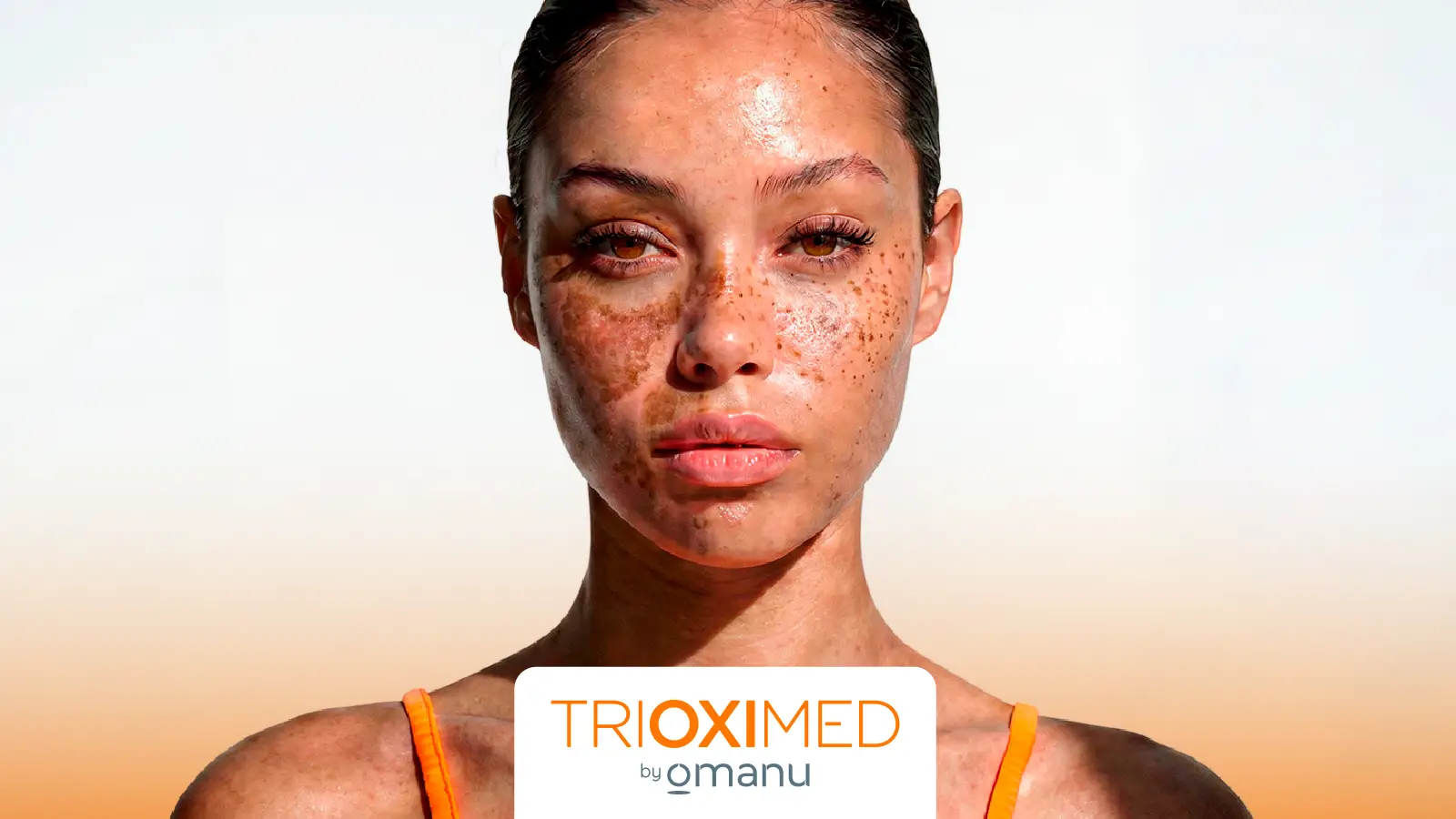Mujer con melasma y manchas solares en el rostro causadas por hiperpigmentación facial y daño solar