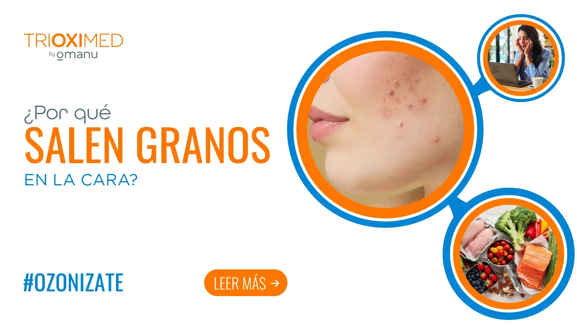 ¿Por qué salen granos en la cara? Imagen sobre las causas más comunes del acné, incluyendo cambios hormonales, alimentación y exceso de grasa.