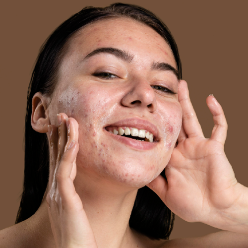 Limpieza facial para piel con tendencia acneica. Mujer con piel con tendencia acneica aplicando limpiador facial sobre el rostro.