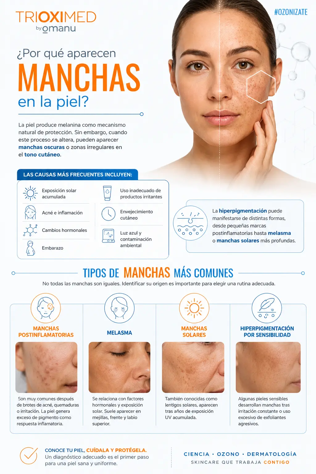 Cómo identificar manchas en la piel: melasma, manchas solares e hiperpigmentación por acné. Infografía sobre tipos de manchas en la piel, causas de hiperpigmentación y melasma con enfoque dermatológico.
